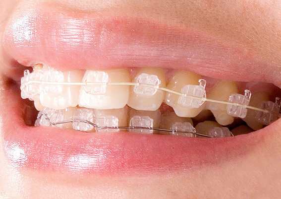 brackets esteticos