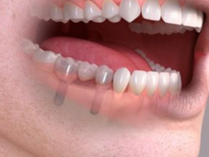 implante dental sevilla varios dientes