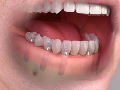 implantes dentales en Sevila toda la boca
