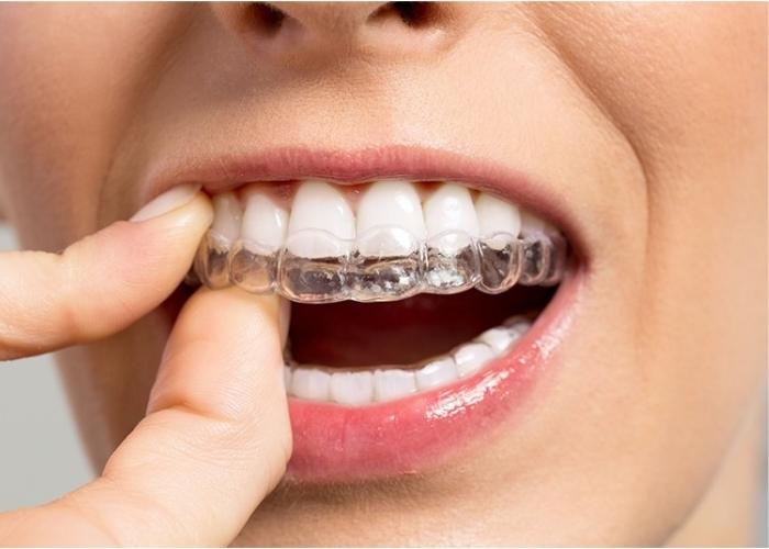 invisalign clinica carmen bernal