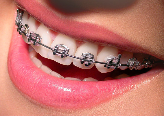 ortodoncia brackets